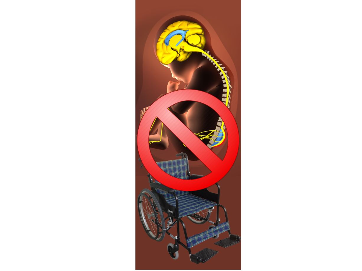 «Жұлын жарығы» үкім емес!