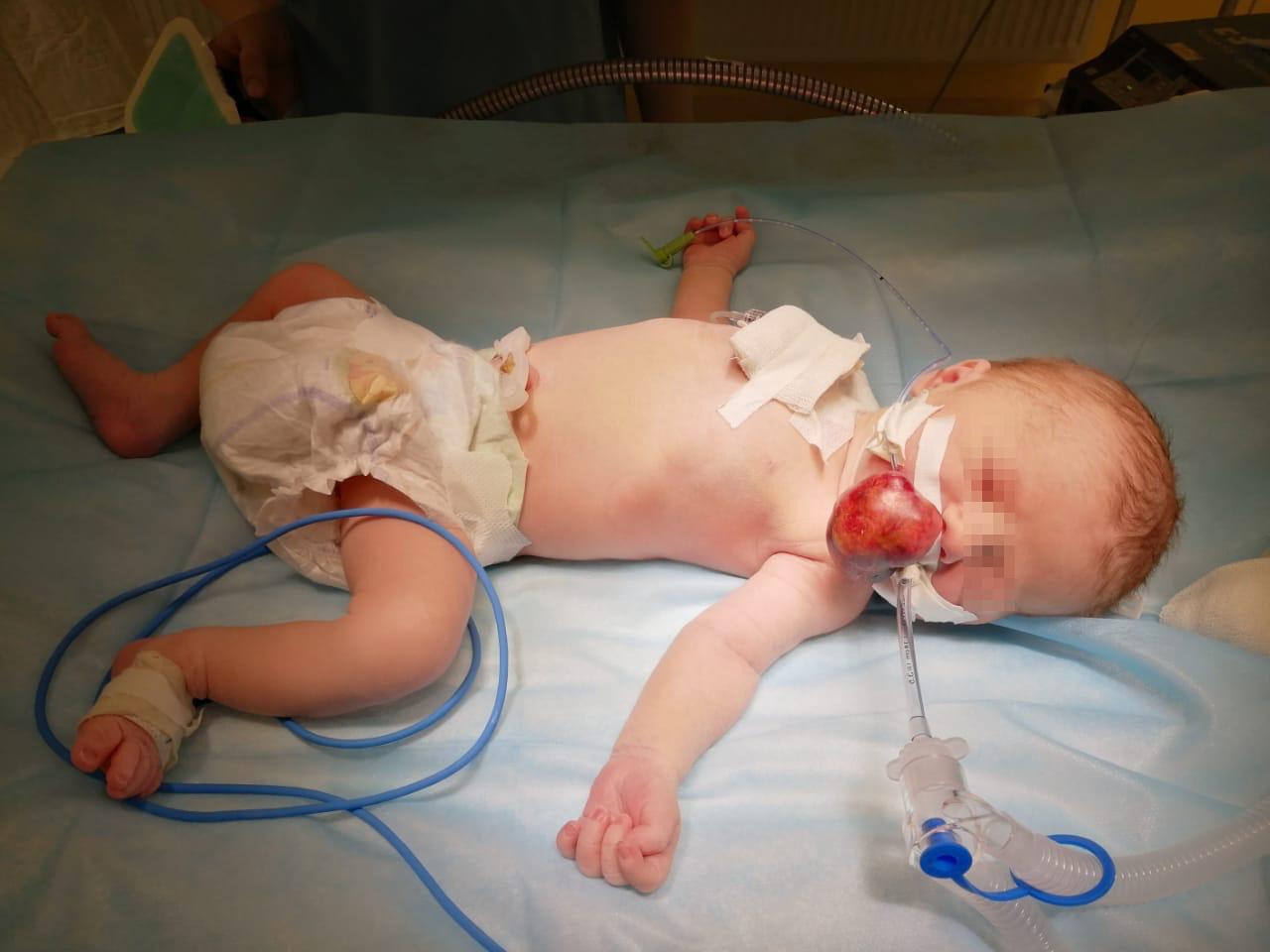 Алматыда жаңа туған шақалаққа күрделі ота жасалды