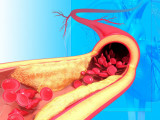 Атеросклероздың алдын алуға болады – Кардиолог дәрігер