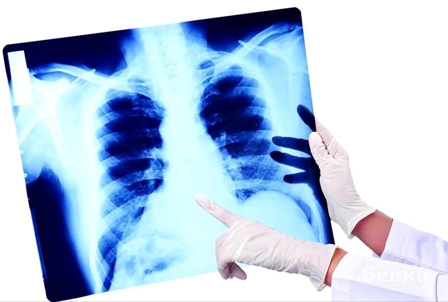 Бір тәулікте 36 адам пневмония дертіне шалдыққан