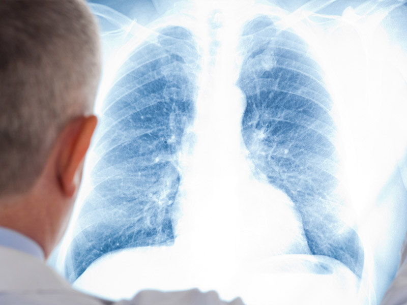 Пневмониядан екі азамат көз жұмды