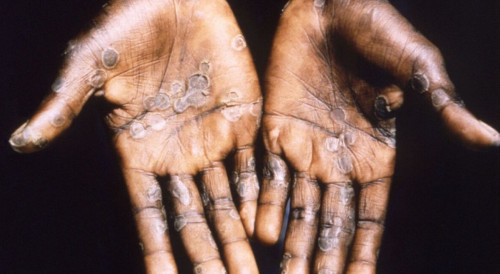 Маймылшешек ауруынан алғашқы өлім жағдайы тіркелді