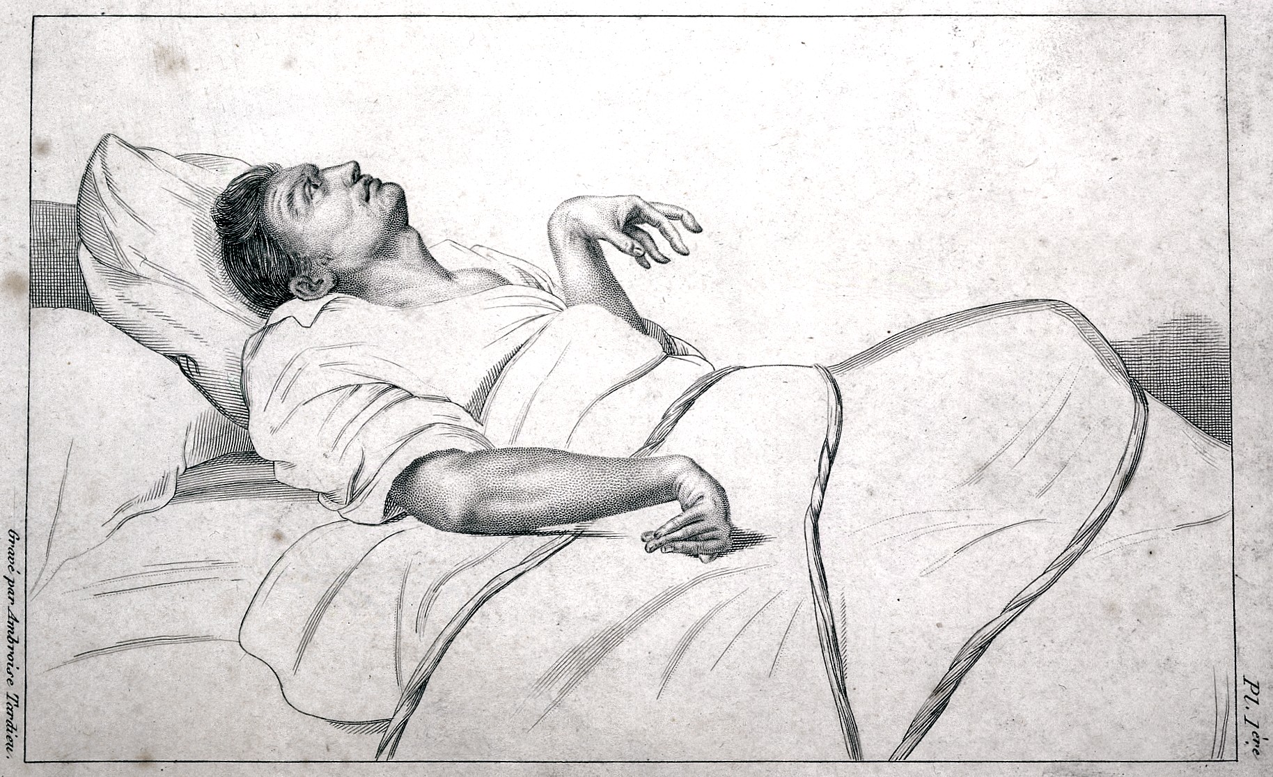 Ескі кесел: Эпилепсияға операция жасауға бола ма?