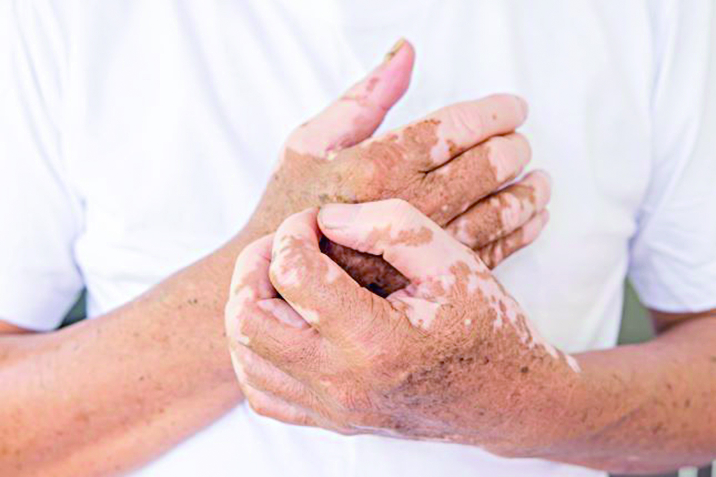 Бес жылда алапес ауруы тіркелген жоқ