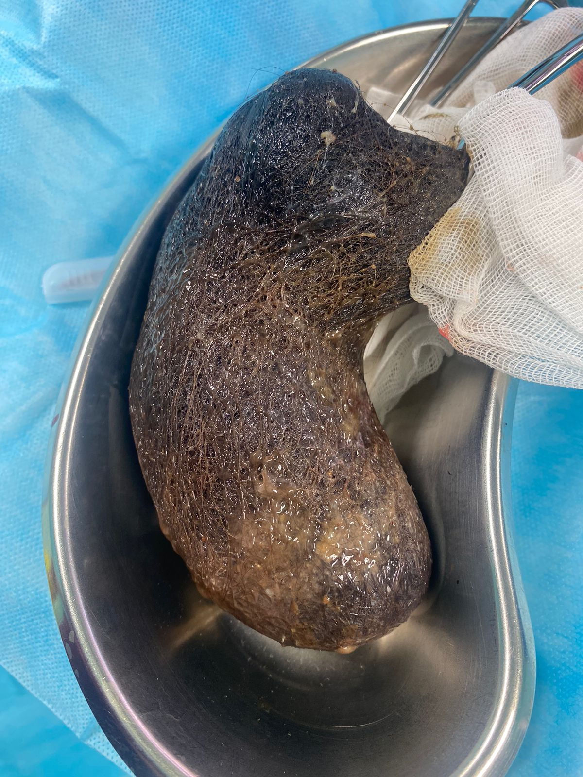 Триотротилломания деген қандай кесел?