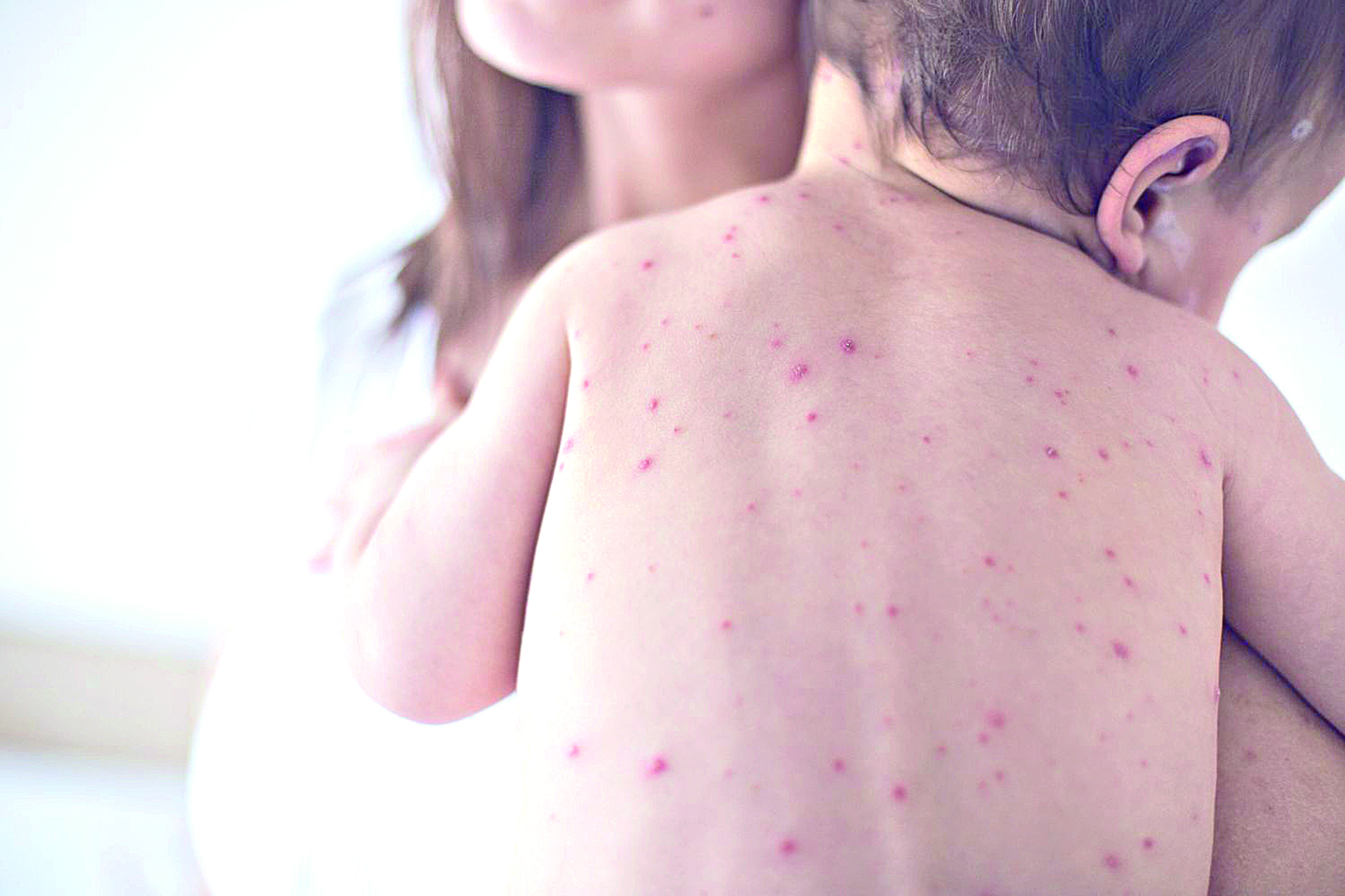 Қызылша ауруының себеп-салдары