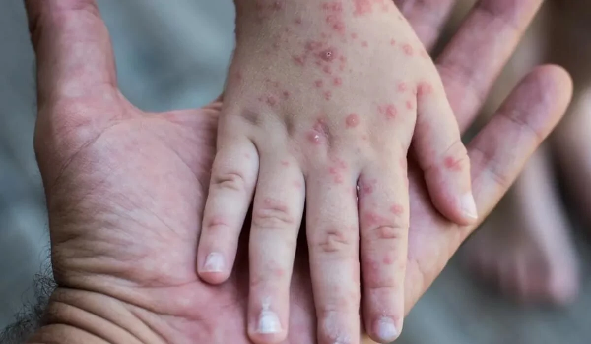 Қызылша жұқтырған 4 бала жансақтау бөлімінде жатыр