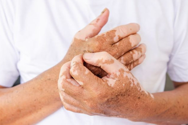 Елімізде соңғы жеті жылда алапес ауруы мүлде анықталмаған