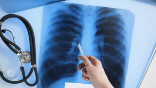 Елімізде туберкулезбен сырқаттанушылар саны азайған