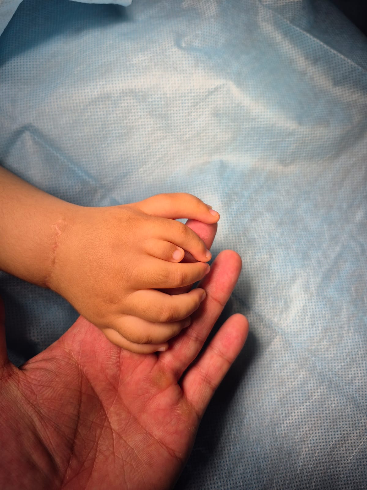 Алматыда 8 саусақпен туған балаға ота жасалды