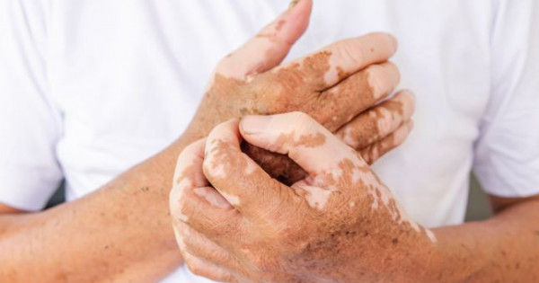 Қазақстанда соңғы сегіз жылда алапес жұқтырғандар тіркелмеген